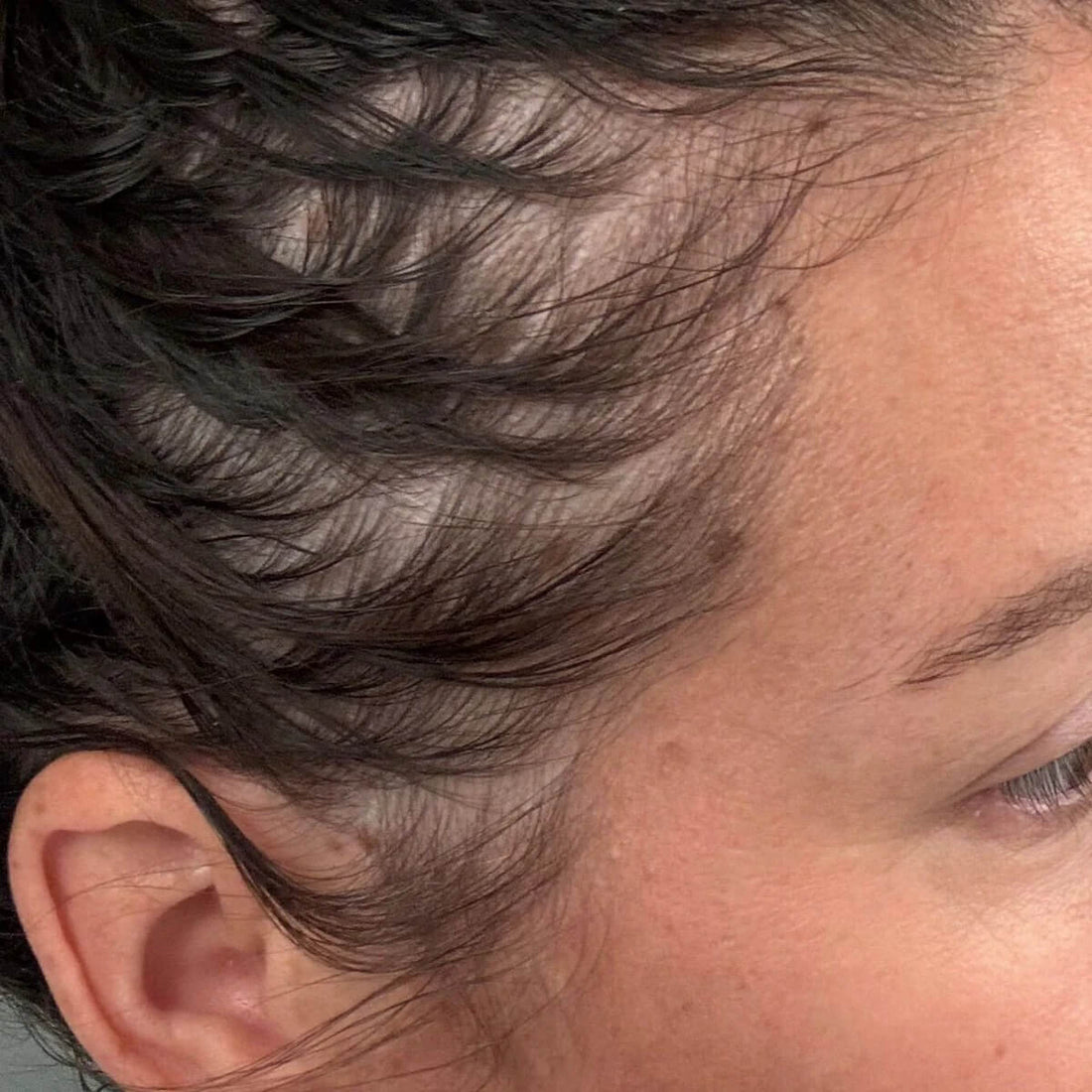 Ferritin, Iron and Hair Loss: What Can Your Blood Tests Reveal?